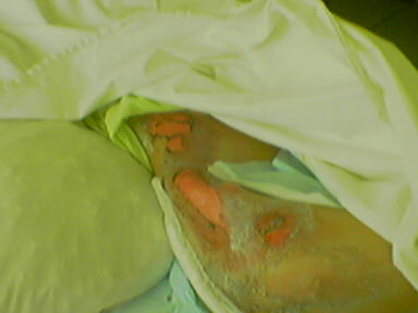 Hronična rana izazvana produženim pritiskom tela na podlogu kreveta